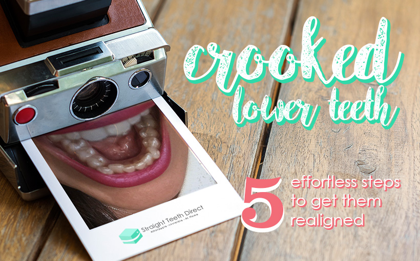 crooked-lower-teeth-5-effortless-steps