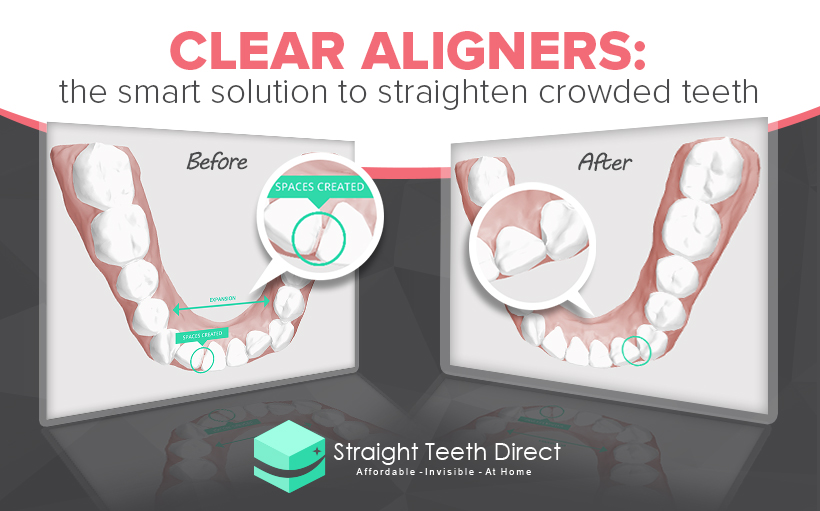 clear aligners for crowded teeth