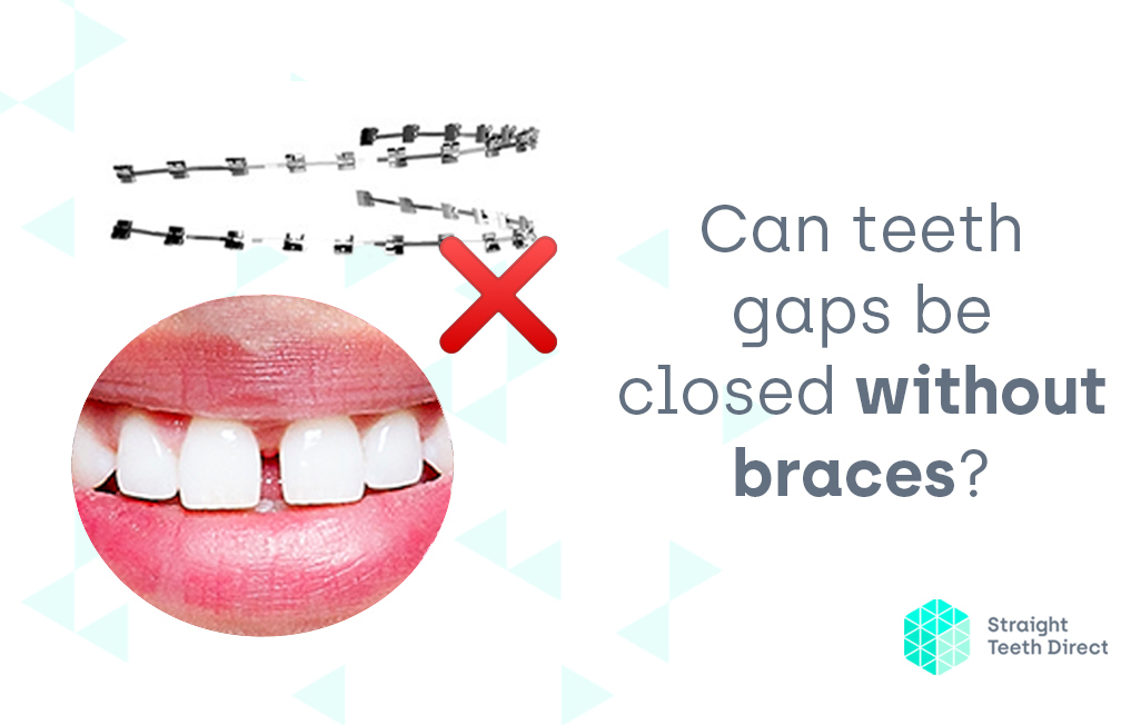 Can teeth gaps be closed without braces