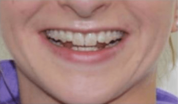 Braces - fixed or removable? 8 points you need to know