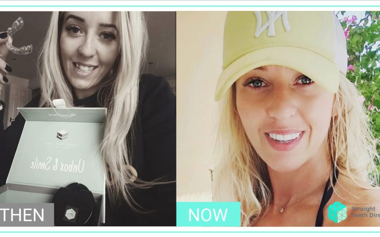 straight teeth from home Marta guest blog