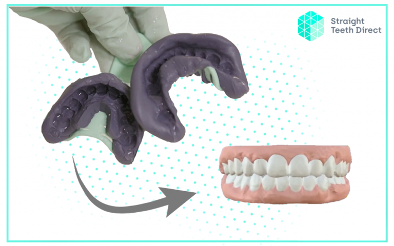 Dental Impressions: How they're used to make your aligners