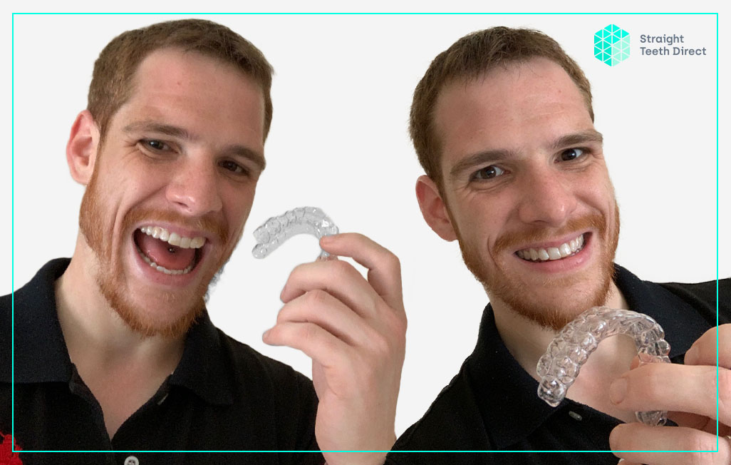 Online teeth straightening for the modern generation - Ben’s testimonial