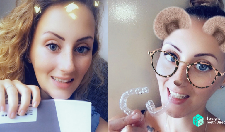 Aligners delivered direct - Toni's guest blog